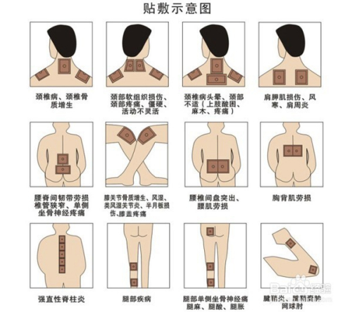 1、肩痛買什么膏藥可以貼？