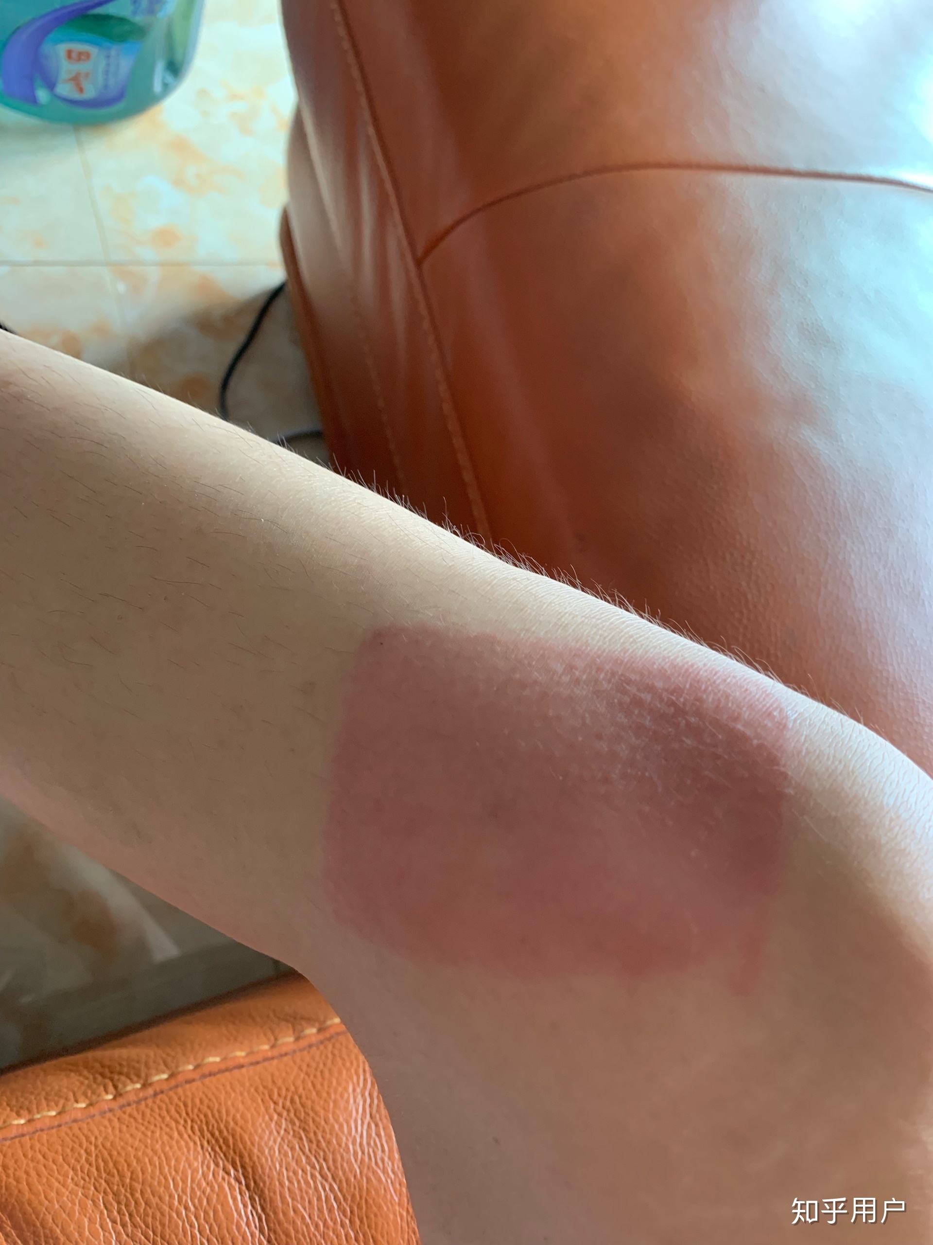 2、貼膏藥的地方有很多紅疙瘩，好不好？